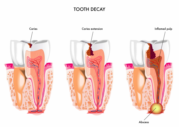 Gainesville Dental Arts Tooth Decay Pain
