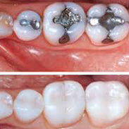 Gainesville Dental Arts Gainesville Haymarket Tooth Colored Fillings