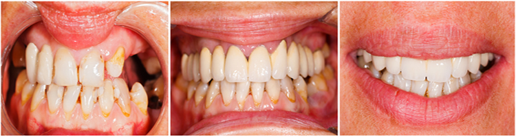 Gainesville Dental Arts Gainesville Haymarket Cosmetic Restorative Implant Bonding Dentistry Before and After