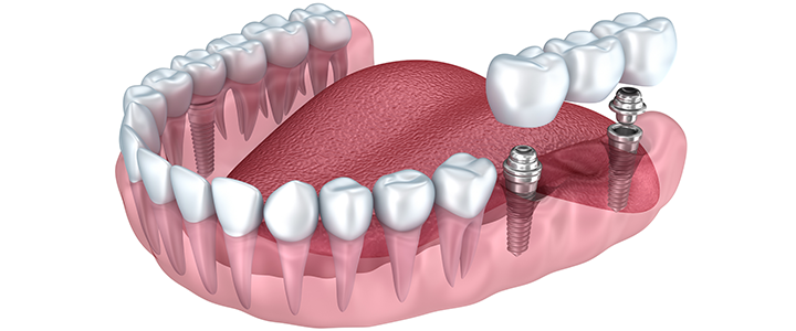 Gainesville Dental Arts Gainesville Haymarket Dental Implants Lower Jaw