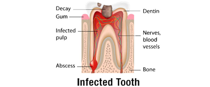 Gainesville Dental Arts Gainesville Haymarket Dental Care Infected Tooth Root Canal