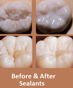 Gainesville Dental Arts Gainesville Haymarket Cosmetic Restorative Before And After Sealants
