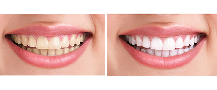 Gainesville Dental Arts Gainesville Haymarket Cosmetic Whitning Before And After