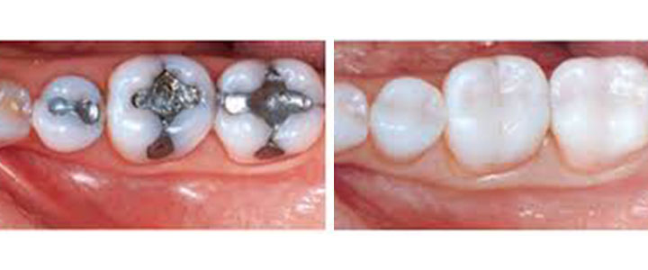 Gainesville Dental Arts Gainesville Haymarket Gentle Professional Tooth Colored Fillings