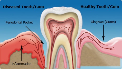 Gainesville Dental Arts Healthy And Infected Gum